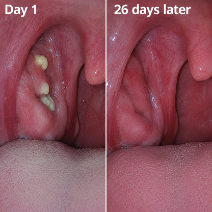 Symbosis - Remove Biofilm & Tonsil Stones To Restore Fresh Breath